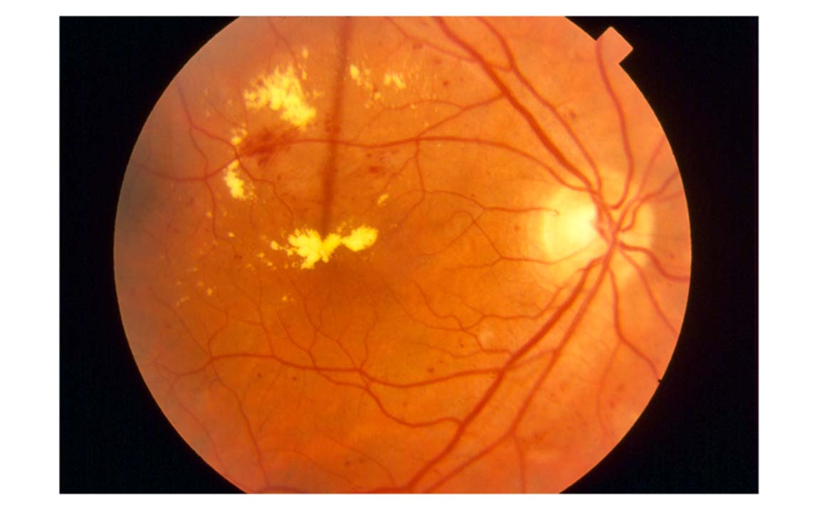 Diabetic Retinopathy Screening & Treatment